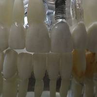 Extremely quality Dental Implants Bulgaria 18