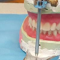 Информация за коронки на зъби 24
