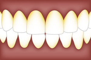 Изберете зъбни импланти 18