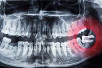 избелване на зъби - 92758 разновидности