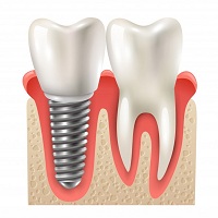 поставяне на зъбни импланти - 90234 цени
