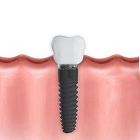 поставяне на зъбни импланти - 20857 промоции