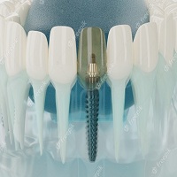 поставяне на зъбни импланти - 61452 промоции