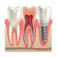 поставяне на зъбни импланти - 84837 новини