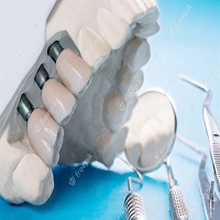 възстановяване след поставяне на зъбни импланти - 84041 бестселъри