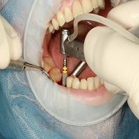 възстановяване след поставяне на зъбни импланти - 84905 вида