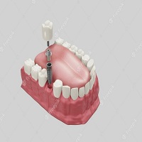 възстановяване след поставяне на зъбни импланти - 7139 промоции