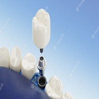 възстановяване след поставяне на зъбни импланти - 49686 бестселъри
