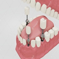 възстановяване след поставяне на зъбни импланти - 83673 комбинации