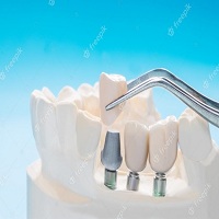 възстановяване след поставяне на зъбни импланти - 3518 отстъпки