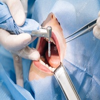 възстановяване след поставяне на зъбни импланти - 60137 новини