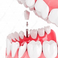 възстановяване след поставяне на зъбни импланти - 4349 варианти