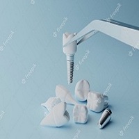 видове зъбни импланти - 73686 снимки