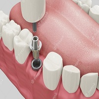 видове зъбни импланти - 50081 цени