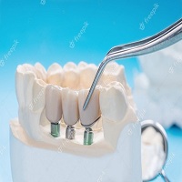 зъбни импланти - 19647 промоции
